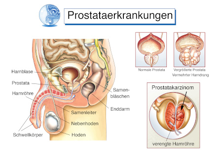 Prostataerkrankungen Inkontinenz beim Mann