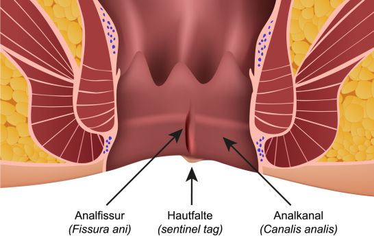 Analfissur