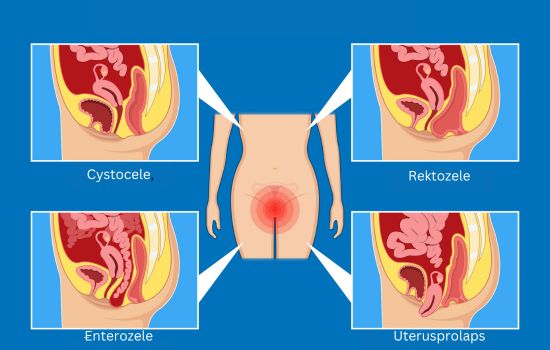 Cystocele, Uterusprolaps, Rektozele und Enterozele