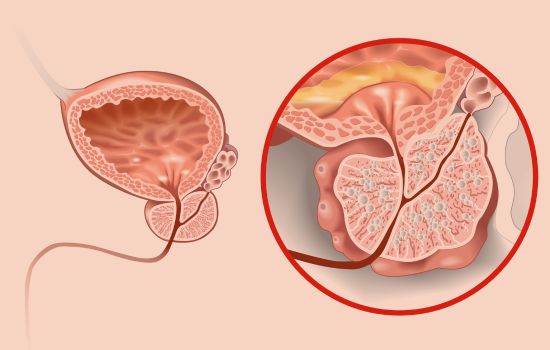 Medikamente zur Behandlung der benignen Prostatahyperplasie