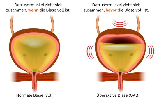 Blasenspeicherstörung