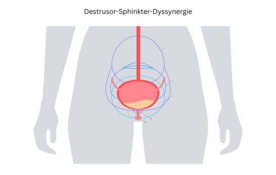 Destrusor-Sphinkter-Dyssynergie