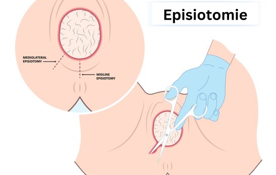 Episiotomien und ihre Folgen: Der Fokus auf Inkontinenz