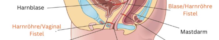 Extraurethrale Inkontinenz