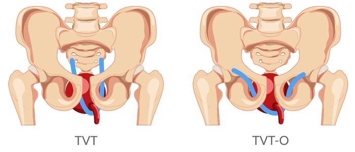 Tension-free Vaginal Tape (TVT) und Transobturator Tape (TOT) Tension-free Vaginal Tape (TVT) und Transobturator Tape (TOT)