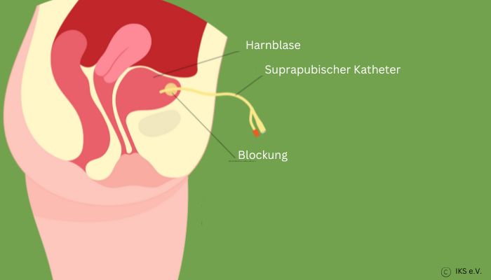 Suprapubischer Katheter