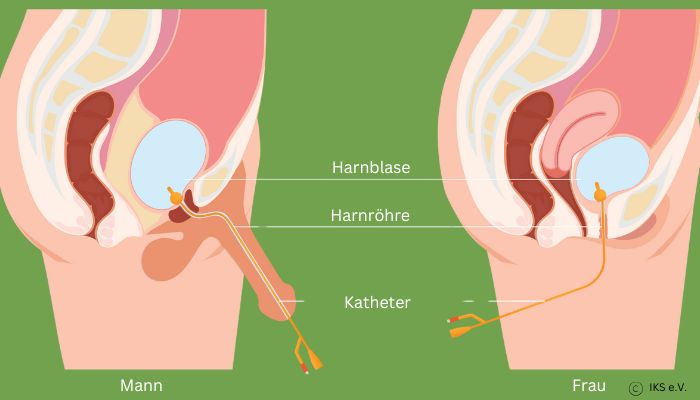 Transurethraler Harnröhrenkatheter