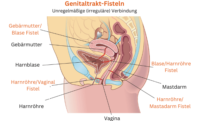Fistelbildung an Darm, Blase oder Gebärmutter - Fisteln Fisteln an und zwischen Blase, Darm und Gebärmutter